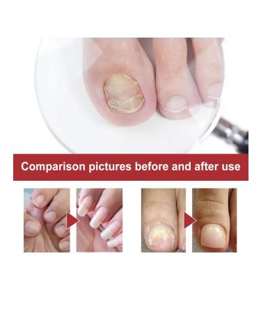 Treatment of fungal infections of care of nails with a solution of 10 mi - Buy Online on GoSupps.com