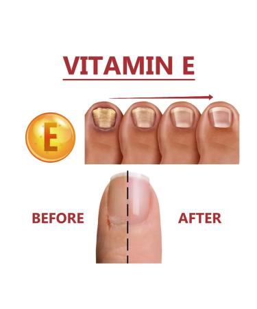 Treatment of fungal infections of care of nails with a solution of 10 mi - Buy Online on GoSupps.com
