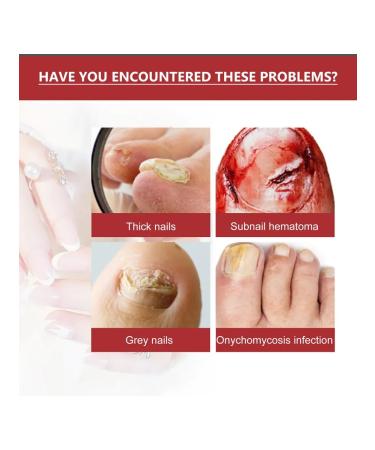 Treatment of fungal infections of care of nails with a solution of 10 mi - Buy Online on GoSupps.com