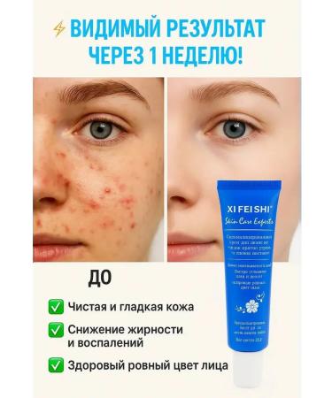 TAR Pimpling cream for problem skin