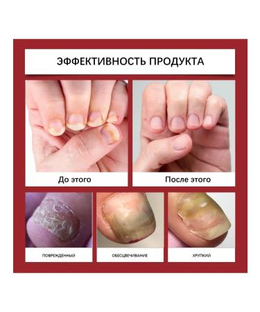 Restorative nails Protective patch Eliminate fungi - Buy Online on GoSupps.com