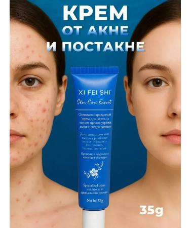 MOON2705 Cream from acne and post -acne from acne and acne rash
