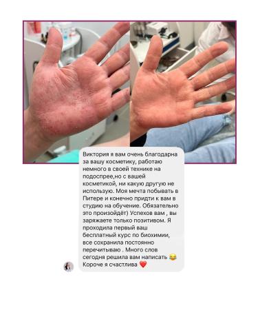 ROSILAK A set of means from eczema dermatitis psoriasis - Buy Online on GoSupps.com