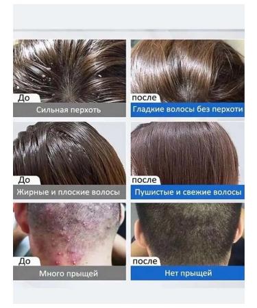 Anti-dandruff shampoo for hair - Buy Online on GoSupps.com