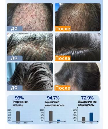 LYDIMOON Shampoo from dandruff removes the itching of the scalp 300 ml - Buy Online on GoSupps.com