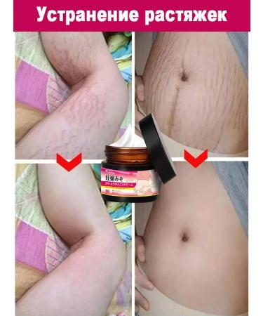 Stretching cream for pregnant women Removing stretch marks