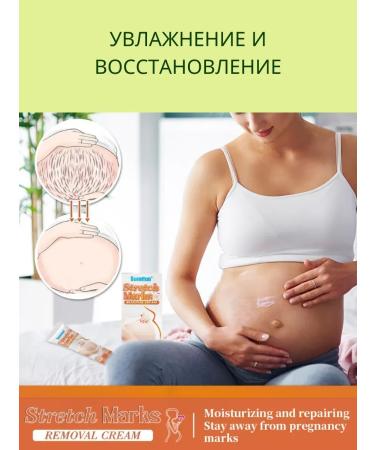 KEVO Cream from stretch marks for pregnant women on the stomach and chest - Buy Online on GoSupps.com