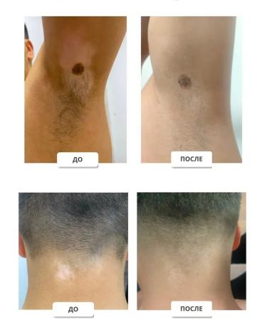 Gintensive Vitiligo cream for pigmented white stains of the skin - Buy Online on GoSupps.com