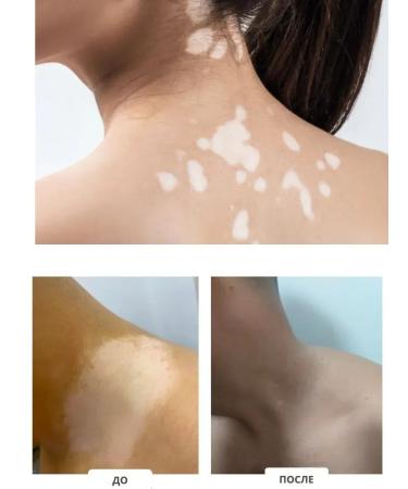 Gintensive Vitiligo cream for pigmented white stains of the skin - Buy Online on GoSupps.com