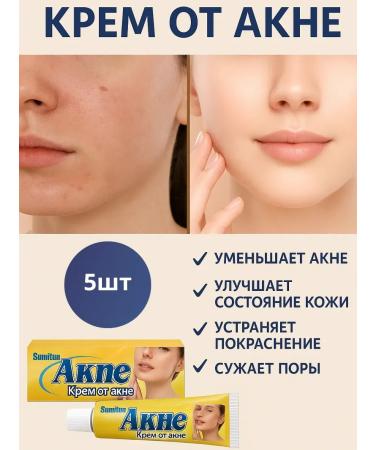 Tilek Acne cream