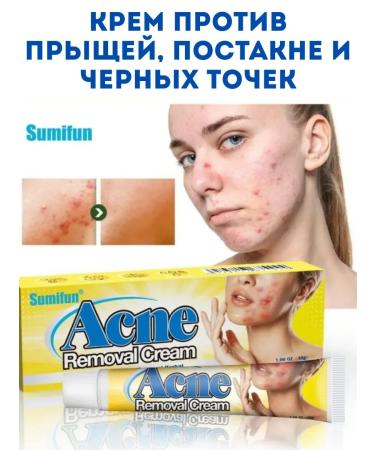 Vlar BEAUTY Acne cream on the face against acne