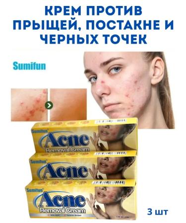 Vlar BEAUTY Acne cream on the face ointment against acne 3 pcs