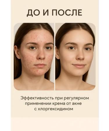 Life1 remedy for acne and acne for teenagers miracle ointment 5 pcs - Buy Online on GoSupps.com