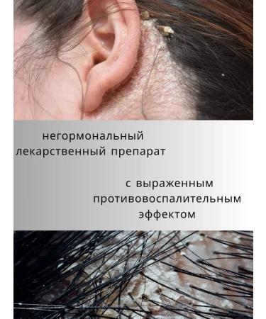 Gintensive Remedy for dandruff and seborrheic dermatitis 1 pc - Buy Online on GoSupps.com