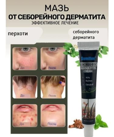 Life Antifungal cream from itching dandruff seborrheic dermatitis