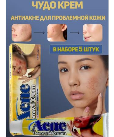 AilunaI 5pcs anti -acne cream against acne on the face and body