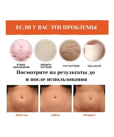 AlexaMM Pregnant stretch marks - Buy Online on GoSupps.com