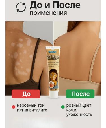 OLBY Skin cream with vitiligo and impaired pigmentation - Buy Online on GoSupps.com