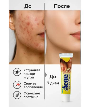 TIA Cream against acne and inflammation 5 pcs - Buy Online on GoSupps.com
