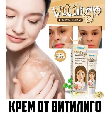 Spoty Brand Ointment from pigment spots from vitiligo cream - Buy Online on GoSupps.com