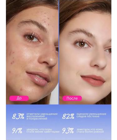 VOIS Face cream with salicylic acid from acne 50 ml - Buy Online on GoSupps.com