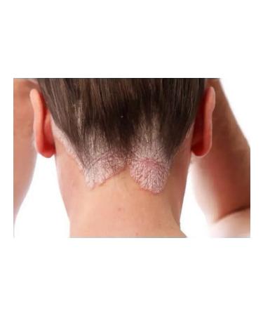 My Sweet Home Atopic dermatitis Cream from dandruff itching crust - Buy Online on GoSupps.com