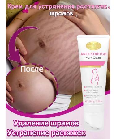 AICHUN BEAUTY Body cream from stretch marks for pregnant women and adolescents 100 g