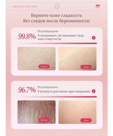 AICHUN BEAUTY Body cream from stretch marks for pregnant women and adolescents 100 g - Buy Online on GoSupps.com