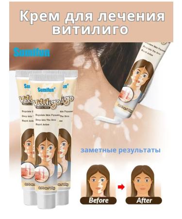 MELUX White spots cream 20 g Restoration from vitiligo - Buy Online on GoSupps.com