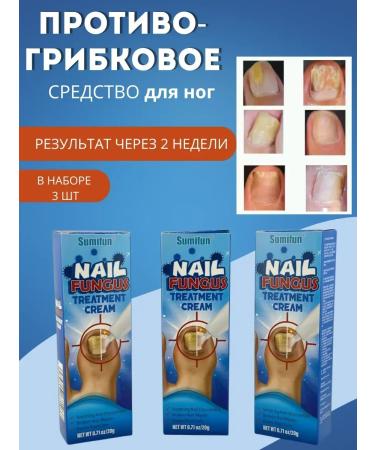 BIRKAZHY Cream for nail care with a fungus 3 pcs