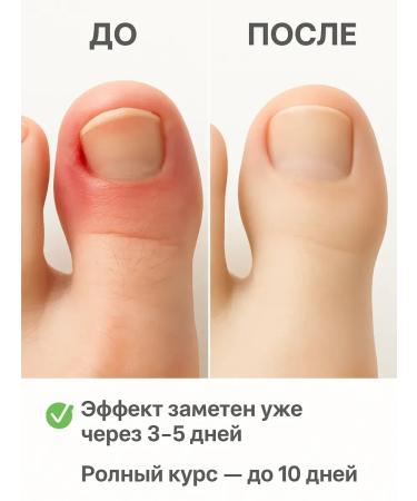 DDE intensive A remedy for an ingrown nail 5pcs - Buy Online on GoSupps.com