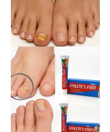 Ointment from nail fungus with natural composition - Buy Online on GoSupps.com