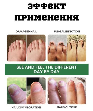 KEVO Cream against the nail fungus smell of the legs from candida - Buy Online on GoSupps.com