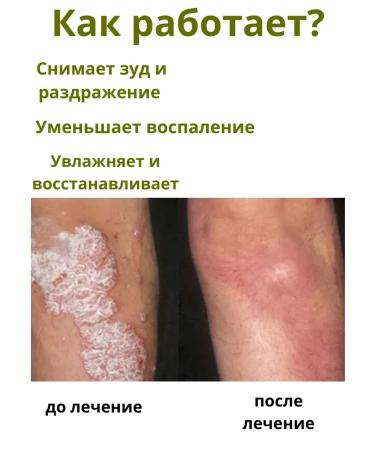 BIRKAZHY Therapeutic ointment from dermatitis and psoriasis 5pcs - Buy Online on GoSupps.com