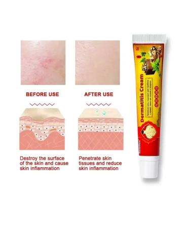 Nail25 beauty and health Dermatitis cream - Buy Online on GoSupps.com