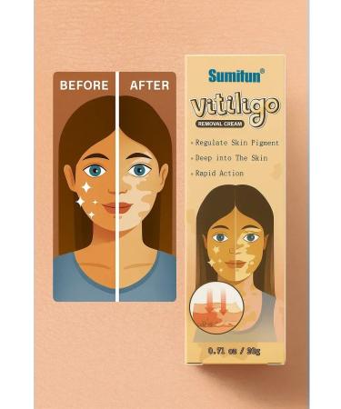 MK77 Vitiligo cream 3pcs ointment from freckles and white spots - Buy Online on GoSupps.com
