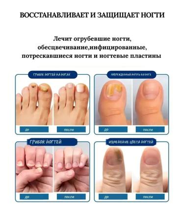 VALLEY Ointment from nail fungus on the legs treatment China - Buy Online on GoSupps.com