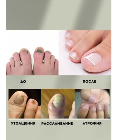 VALLEY remedy for nail fungus treatment treatment - Buy Online on GoSupps.com