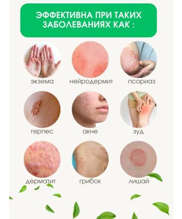 NazzHome Chinese ointment from psoriasis dermatitis and acne - Buy Online on GoSupps.com