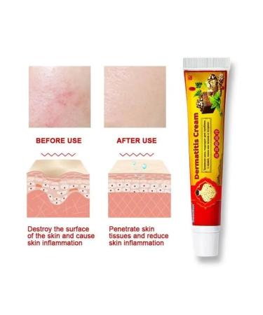 NazzHome Herbal ointment from dermatitis of eczema and psoriasis from itching - Buy Online on GoSupps.com