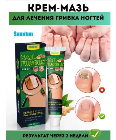datka7 Remedy for nail fungus antifungal ointment