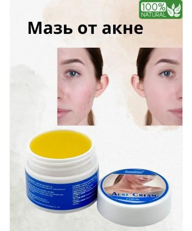 Victoria Cream from skin diseases acne scars acne