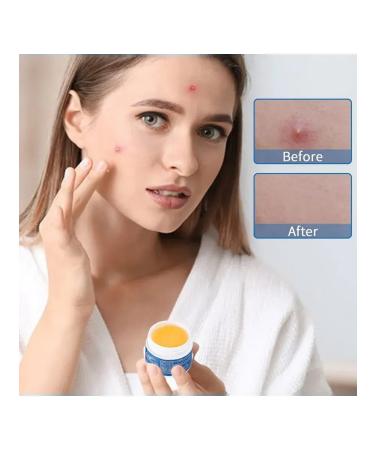 MaxWish 09 Acne cream from acne - Buy Online on GoSupps.com