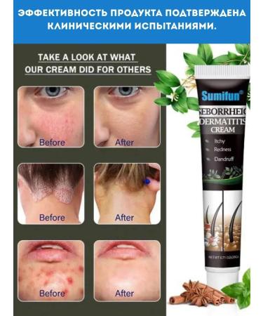 Vlar Cream from seborrheic dermatitis on the head against dandruff - Buy Online on GoSupps.com