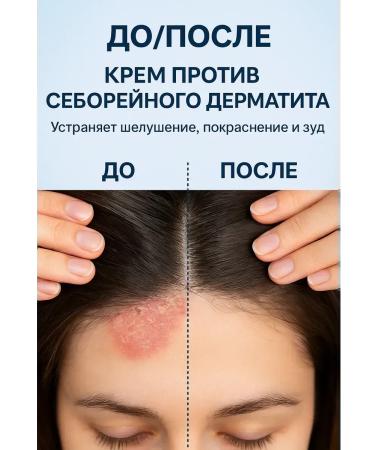 MadiMax Cream from seborrheic dermatitis - Buy Online on GoSupps.com