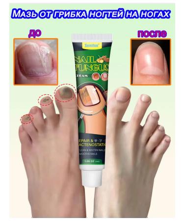 Ointment from nail fungus antifungal 30 ml