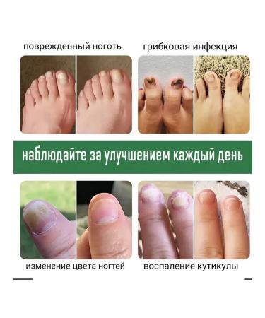 Ointment from nail fungus antifungal 30 ml - Buy Online on GoSupps.com