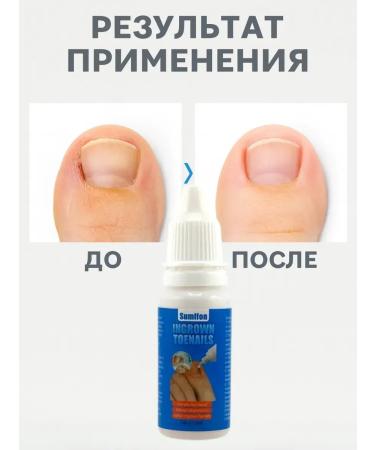muva Remedy for ingrown nails on the legs of pedicure medical - Buy Online on GoSupps.com