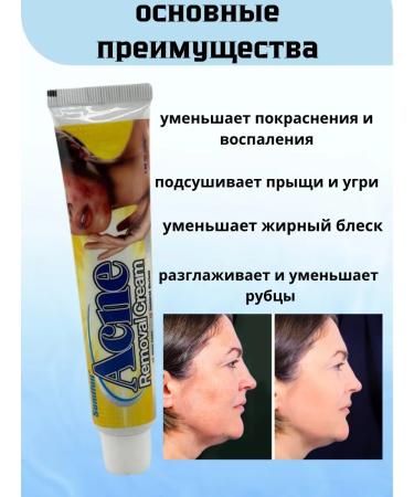 alma2 Acne cream of acne antibacterial - Buy Online on GoSupps.com