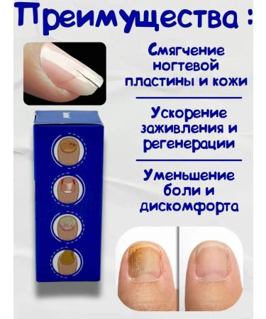 NT83 Drops from an ingrown nail on the legs - Buy Online on GoSupps.com